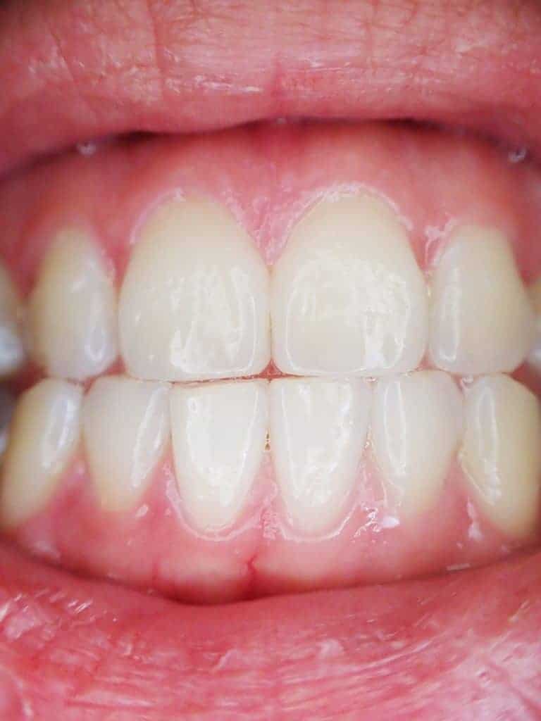 I wish my teeth and gums were this healthy.