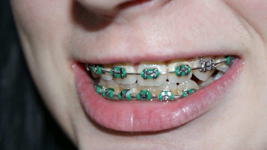 Braces make cleaning your teeth a bitch.